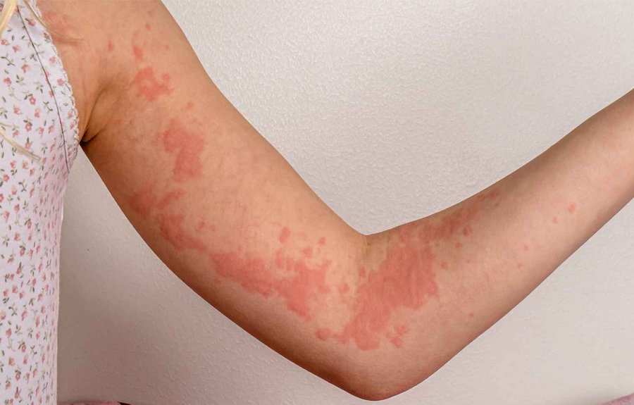 Urticária Crônica Espontânea: o que é, sintomas e como tratar a doença de pele