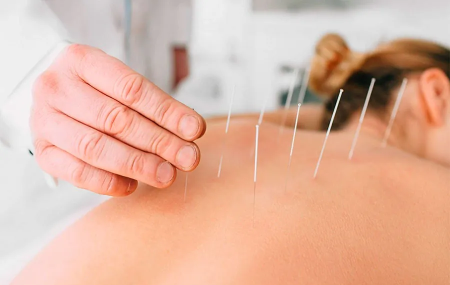 Acupuntura